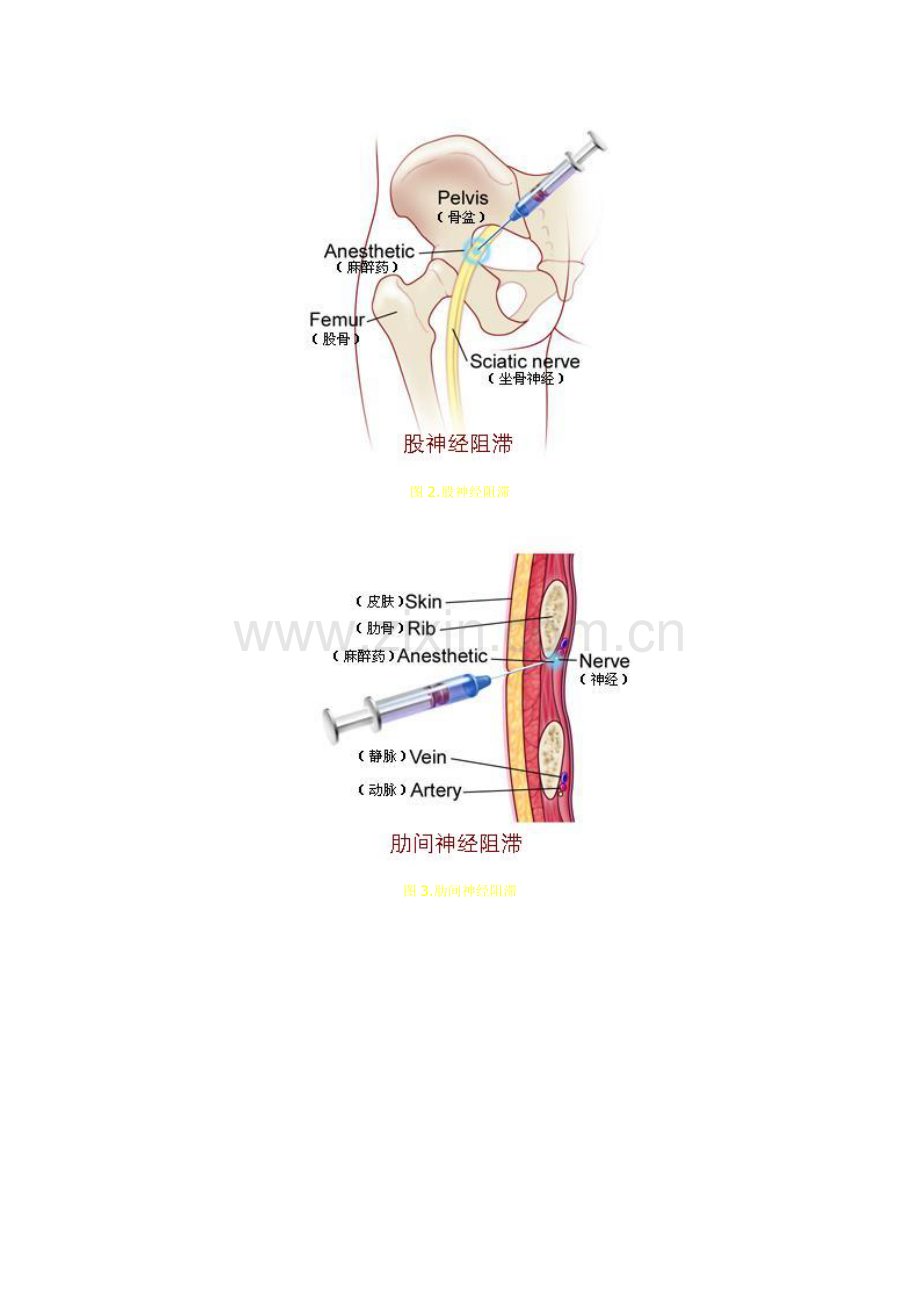 常用麻醉技巧表现图.doc_第2页