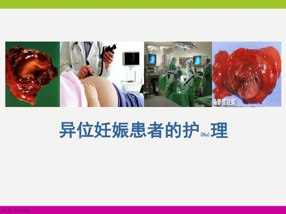 异位妊娠患者的护理概述.pptx_第1页