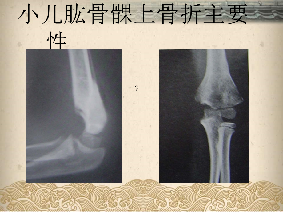 小儿肱骨髁上骨折专题医学知识宣讲.pptx_第2页