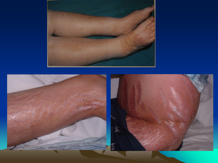 水肿专题知识讲座.ppt_第1页