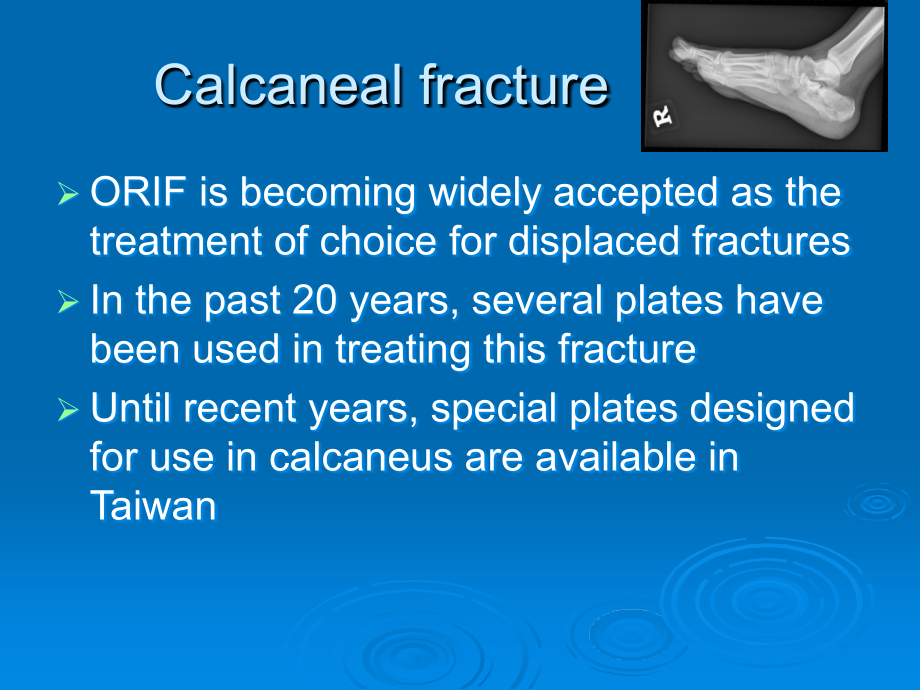 距下关节后关节面塌陷性骨折的治疗新进展.ppt_第2页