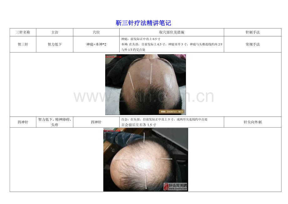 靳三针疗法精讲专业笔记附图.doc_第1页