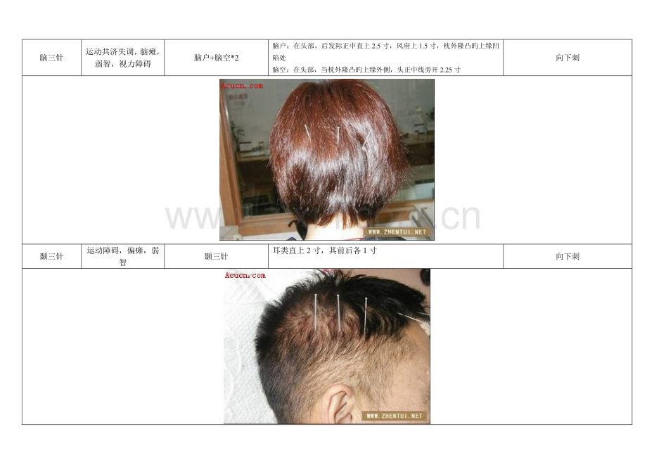靳三针疗法精讲专业笔记附图.doc_第2页