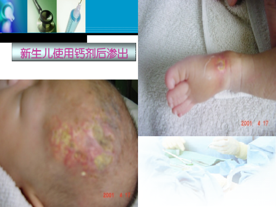 PICC在新生儿的临床应用医学知识讲解.ppt_第2页