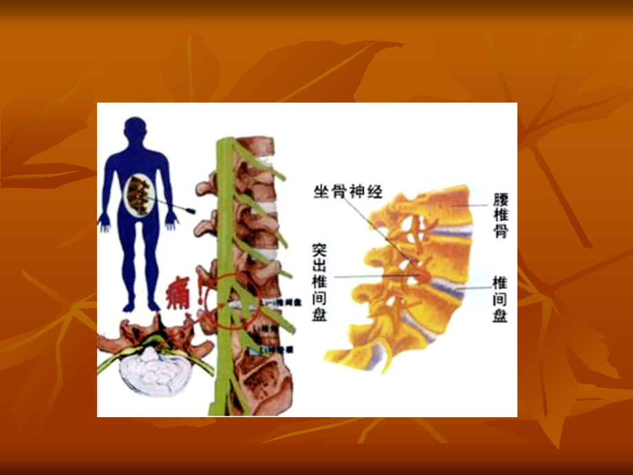 腰椎间盘突出症专题宣讲.ppt_第2页