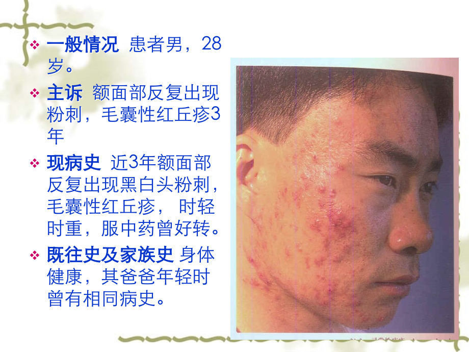 针灸治疗学痤疮.ppt_第2页