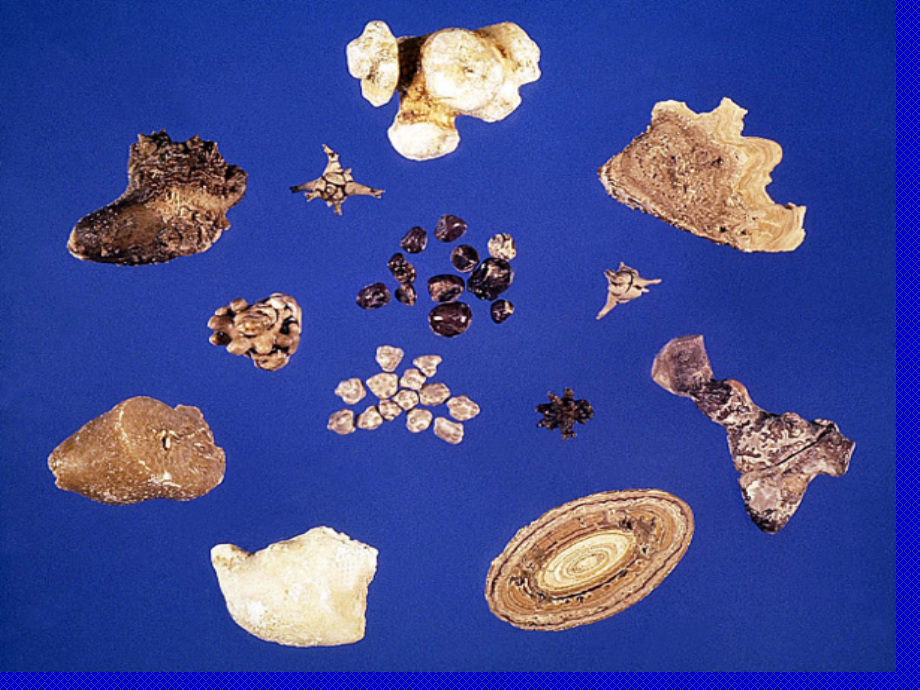 泌尿系结石医学知识宣讲.ppt_第2页