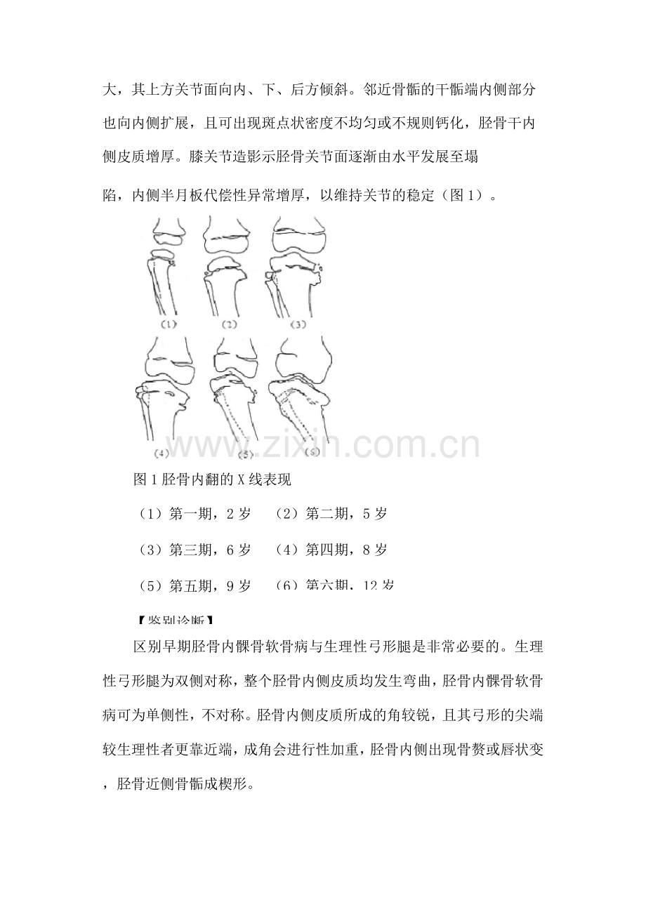 胫骨内髁骨软骨病.docx_第2页