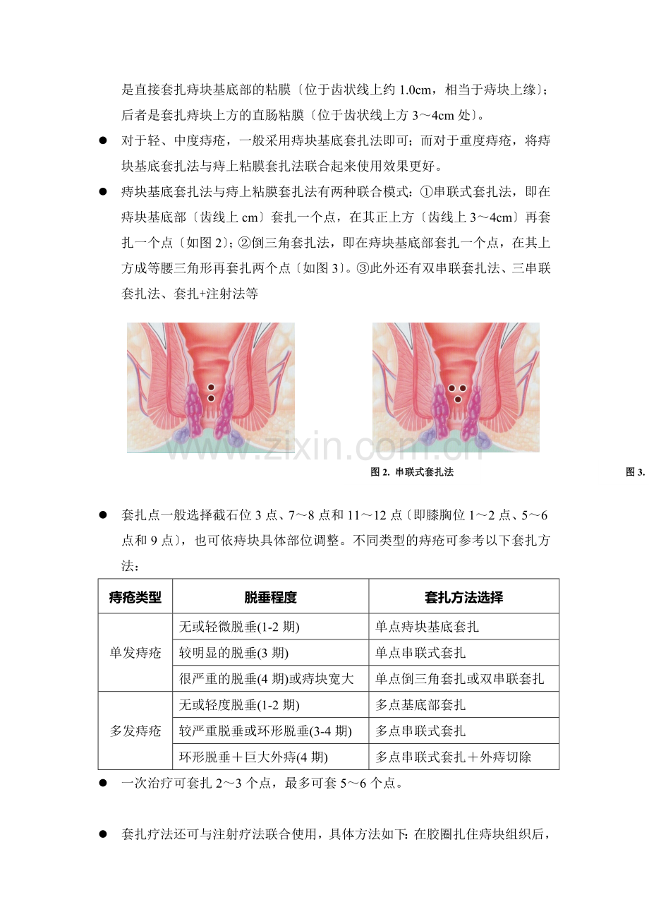 中大福瑞连发式痔疮套扎器操作指南.docx_第2页