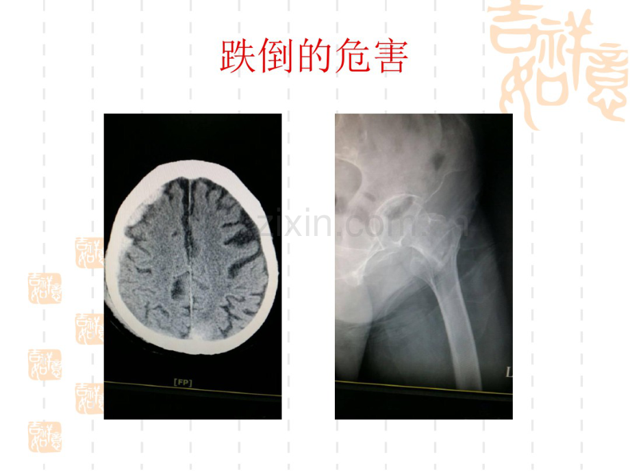 人体平衡和跌倒预防.pdf_第2页