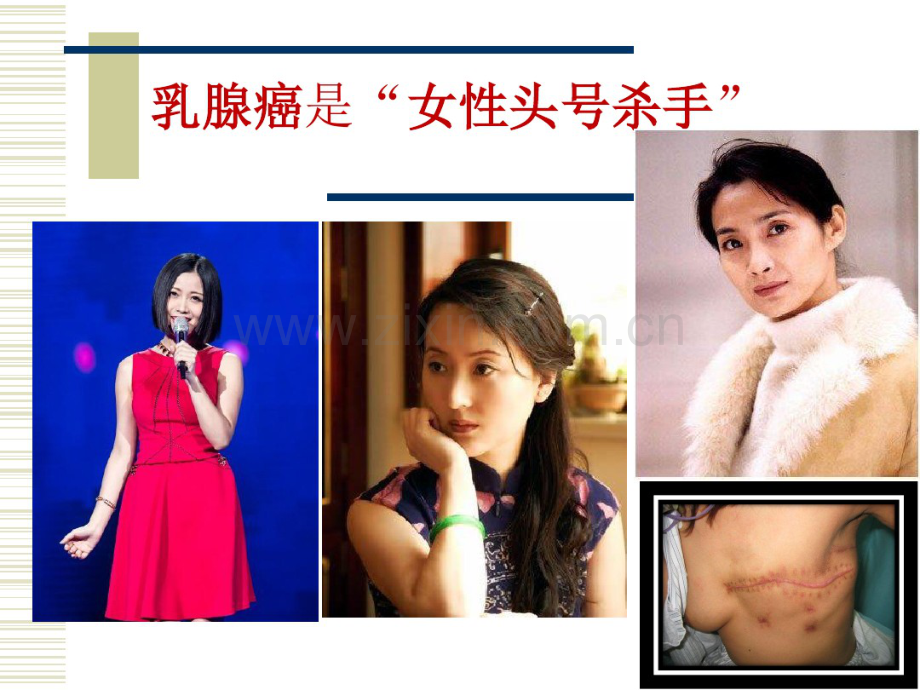 乳腺癌科普宣教.pdf_第2页
