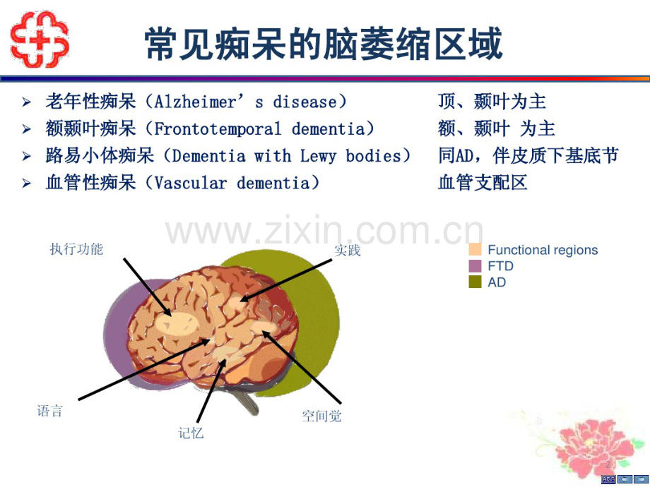 痴呆语言特点及及美金刚的有效治疗-彭丹涛.pdf_第2页