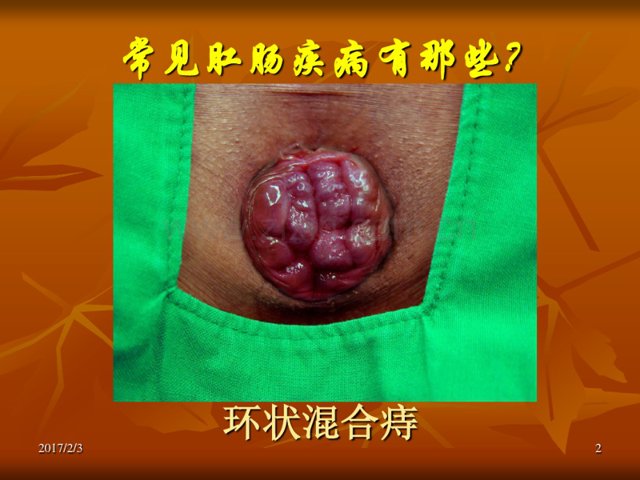 肛肠科科普知识宣讲.pdf_第2页