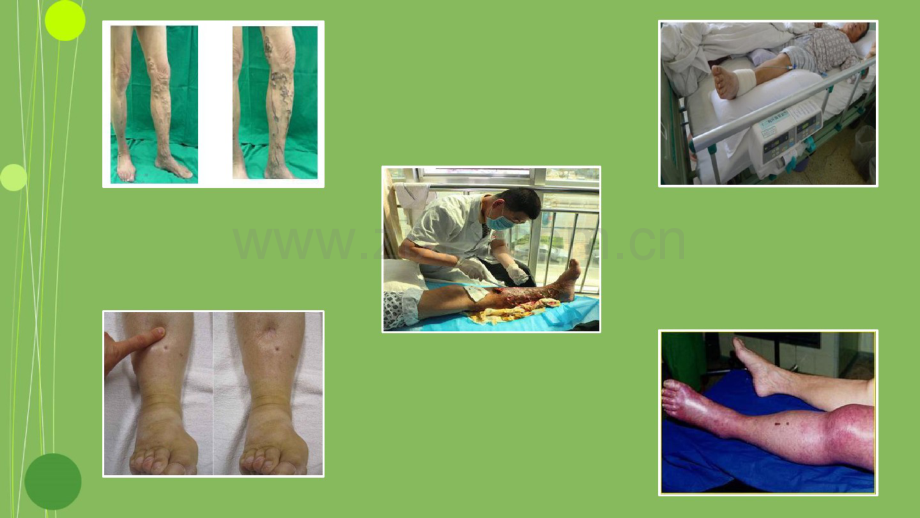 下肢深静脉血栓的预防及护理.pdf_第2页