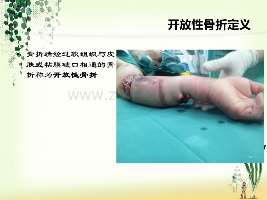 开放性骨折的处理.pdf_第2页