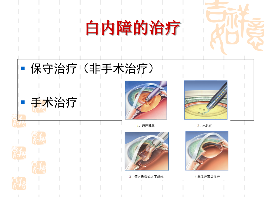 白内障的治疗.ppt_第2页