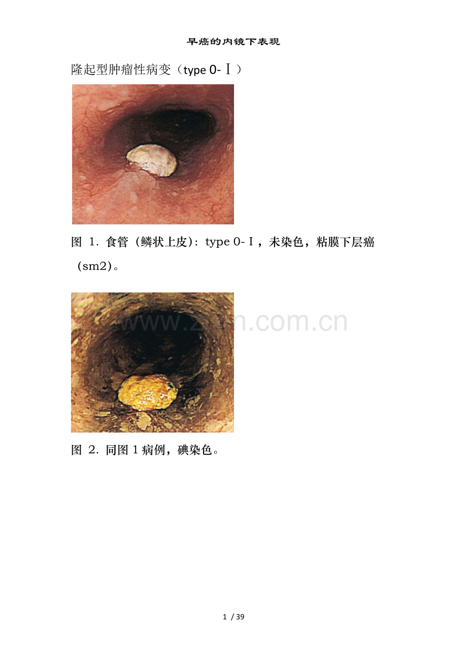 早癌的内镜下表现.doc_第1页