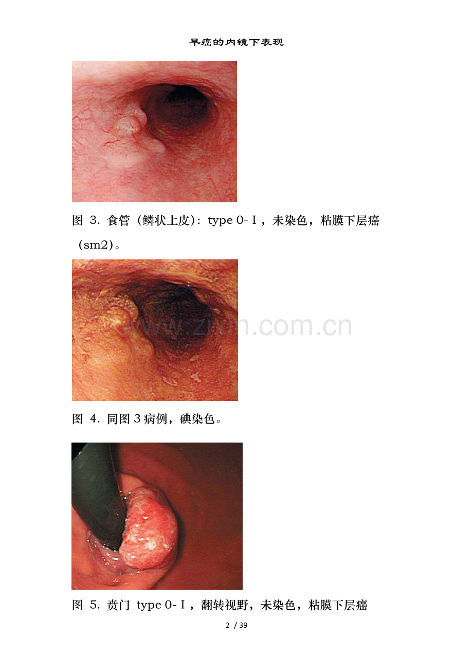早癌的内镜下表现.doc_第2页