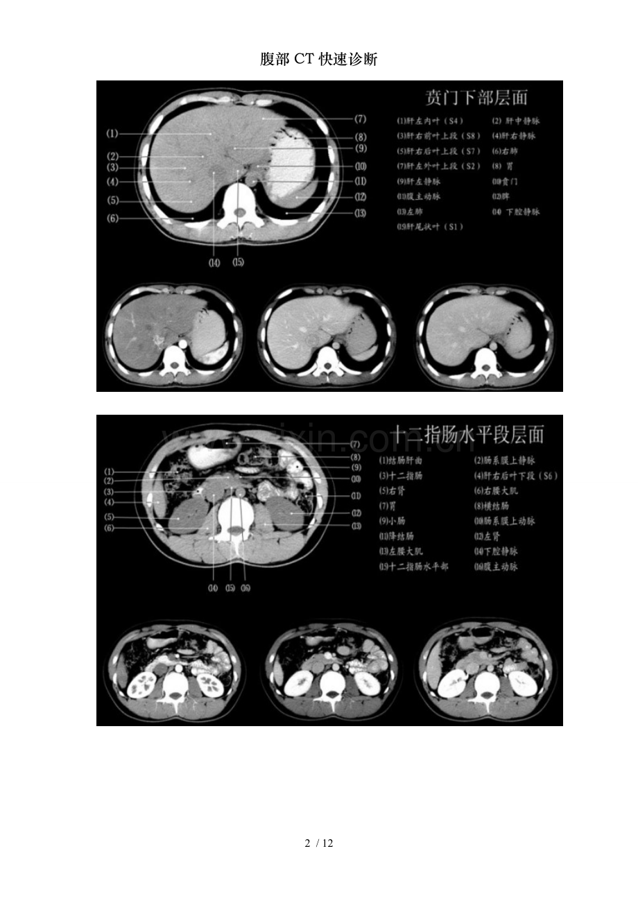 腹部CT快速诊断.doc_第2页