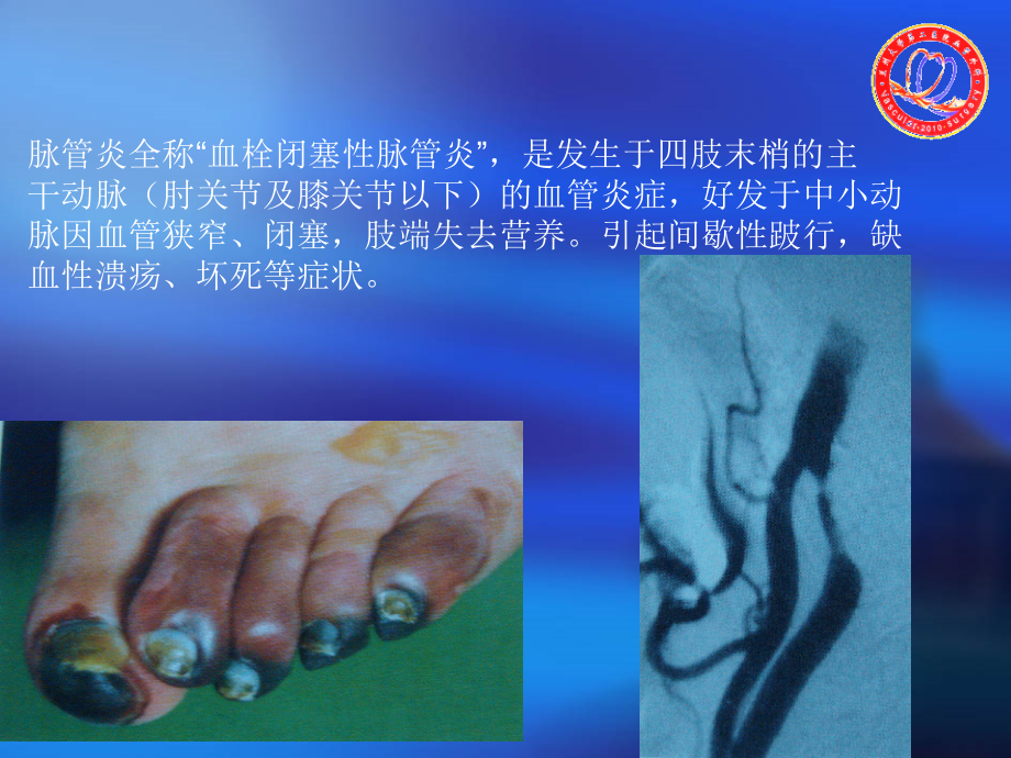 血栓闭塞性脉管炎.ppt_第2页