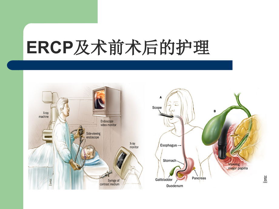 ERCP及术前术后护理培训.ppt_第1页