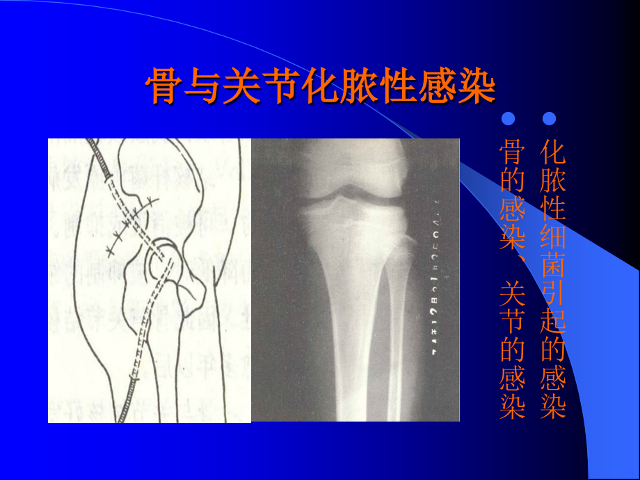 骨与关节感染医学课件.ppt_第2页