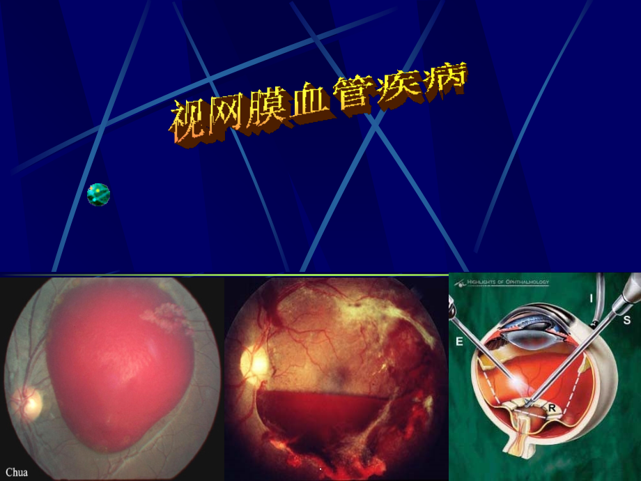 视网膜血管疾病课件.ppt_第1页