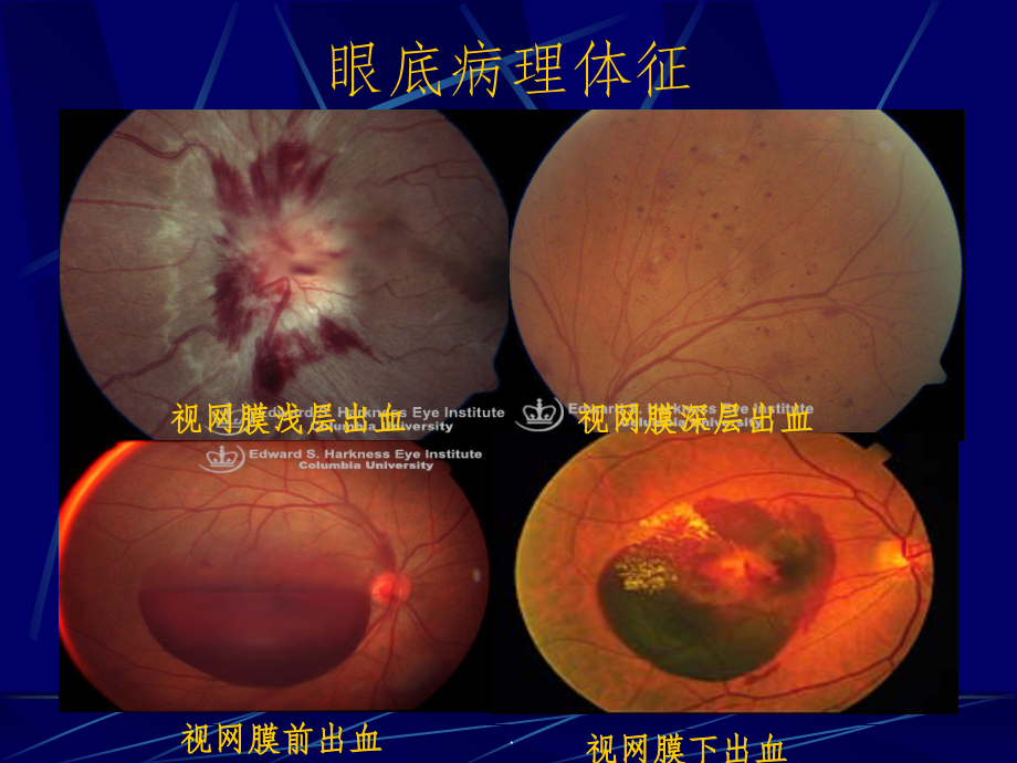 视网膜血管疾病课件.ppt_第2页