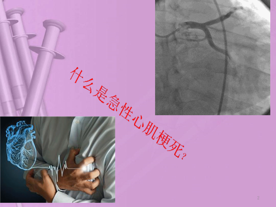 急性心肌梗死的监测及护理.pptx_第2页