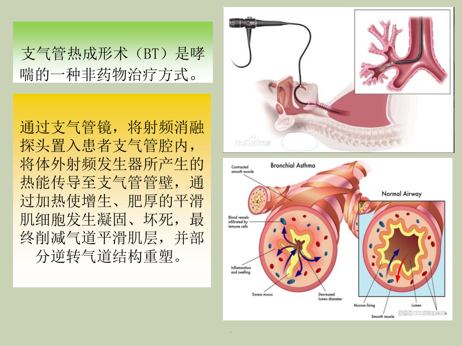 支气管热成形术课件.pptx_第2页