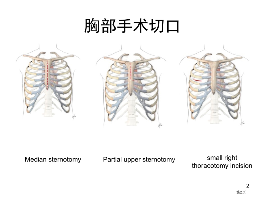 开胸术后镇痛.pptx_第2页