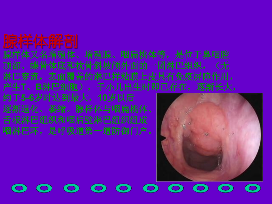 腺样体肥大课件.ppt_第2页