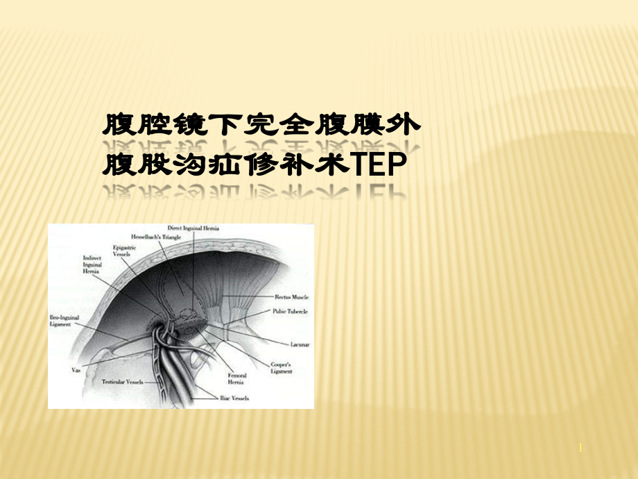 腹腔镜下完全腹膜外腹股沟疝修补术课件.pptx_第1页