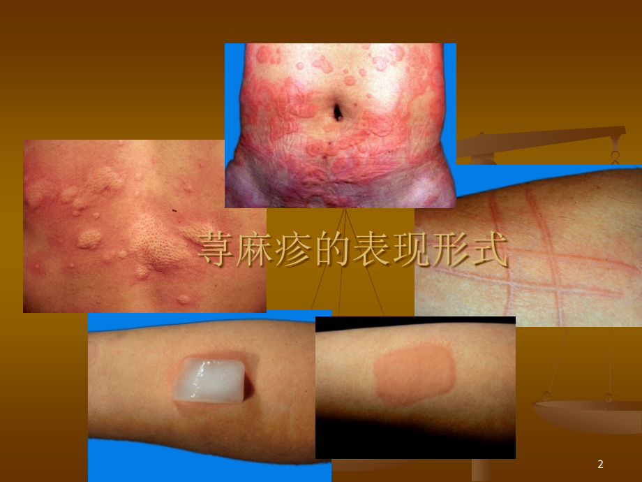 慢性荨麻疹临床诊治的规范化问题.ppt_第2页