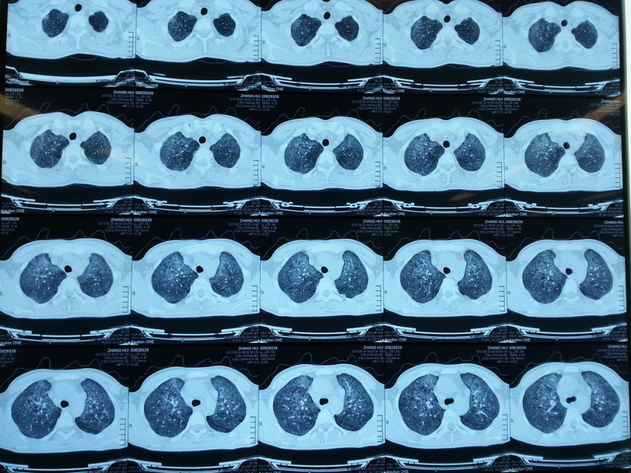 肺孢子菌肺炎宣讲优质课件.ppt_第2页