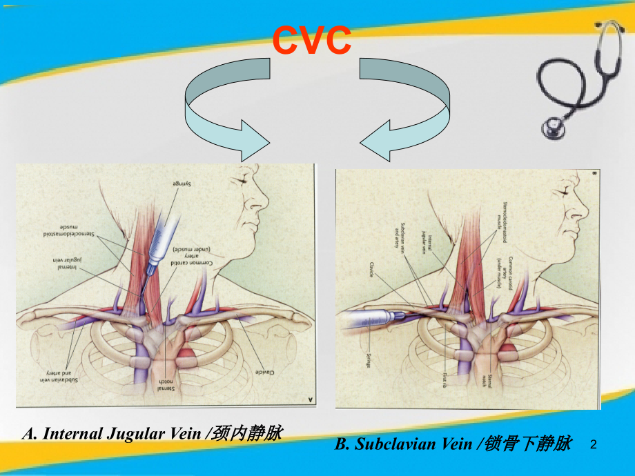 CVCPICC置管护理业务学习.ppt_第2页