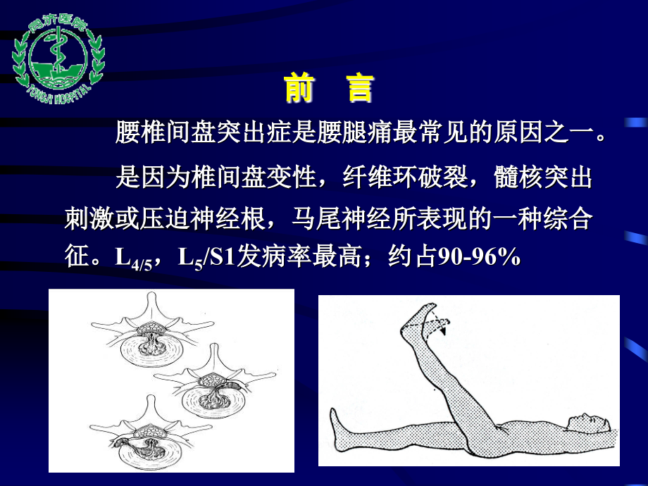 微创手术治疗腰椎间盘突出症(课件).ppt_第2页