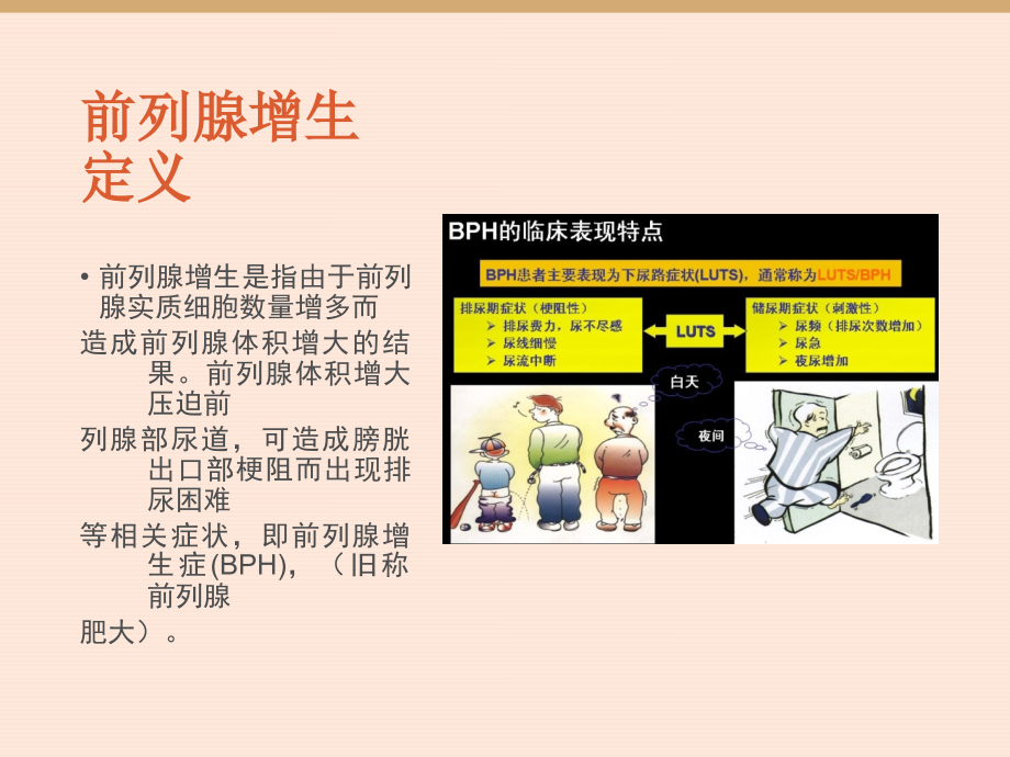 前列腺增生的围手术期护理(课件).ppt_第2页