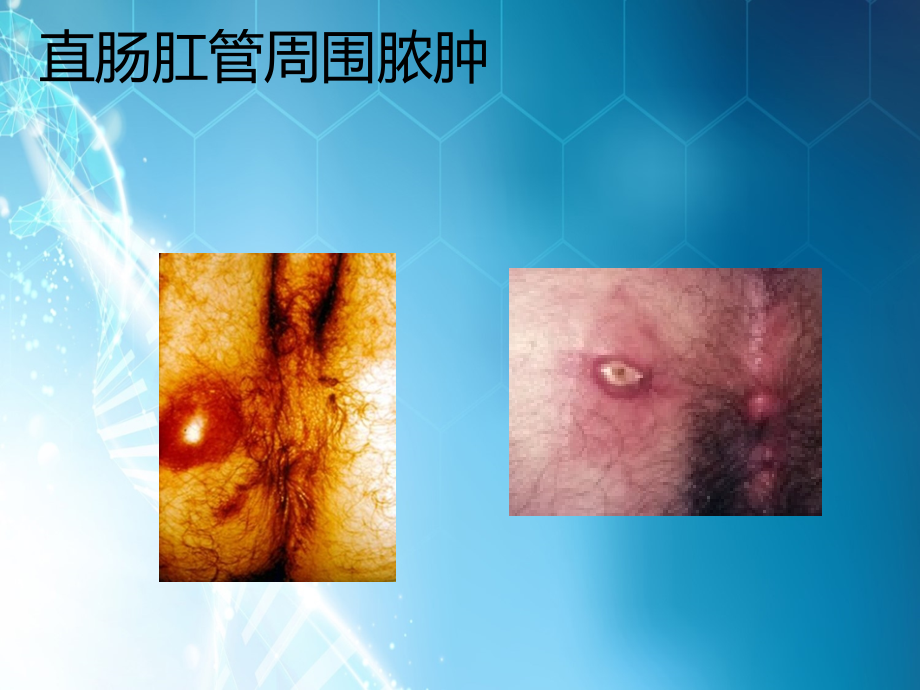 肛周疾病课件.ppt_第2页
