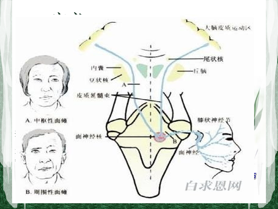 中西医结合治疗周围性面瘫PPT医学课件.ppt_第2页