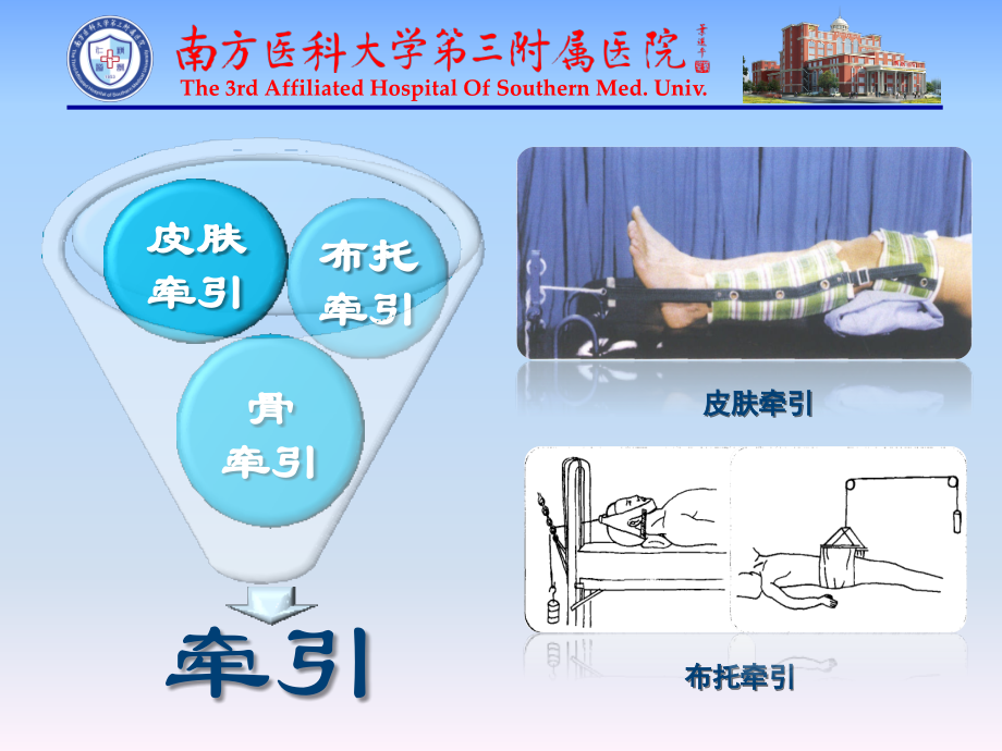 颅骨牵引的护理.ppt_第2页