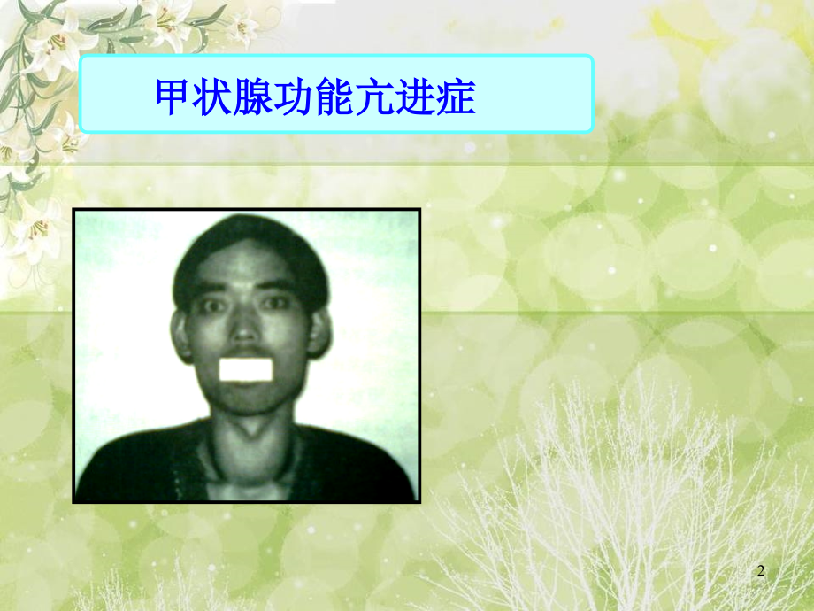 护理查房甲状腺疾病护理.ppt_第2页