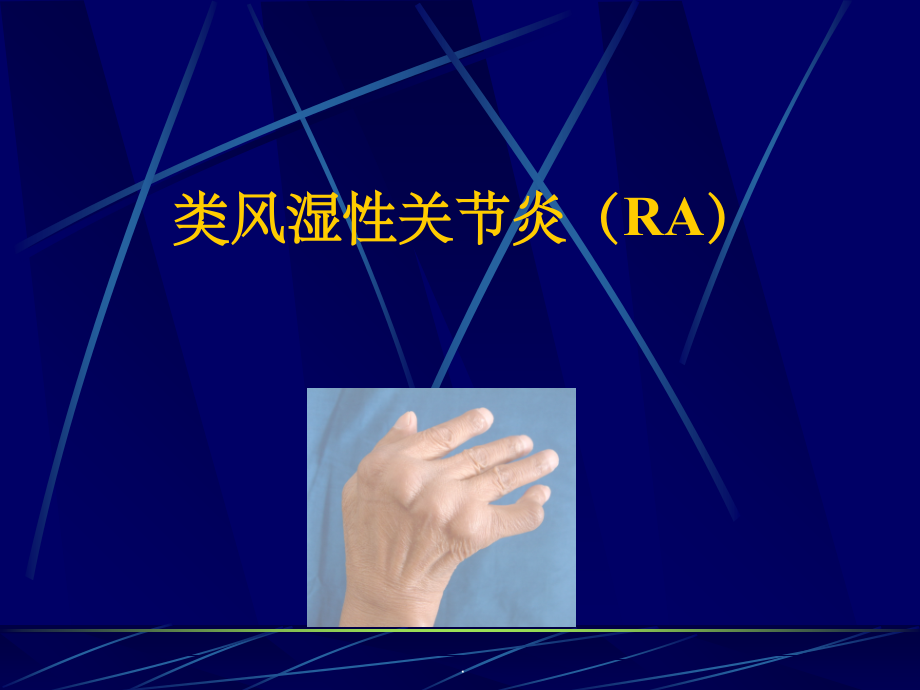 内科学整理类风湿性关节炎.ppt_第1页