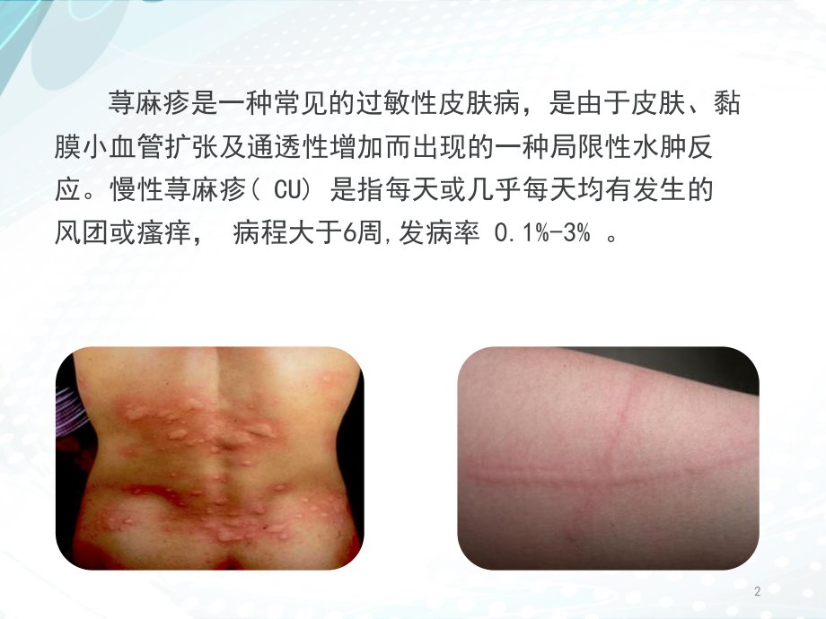 慢性荨麻疹.pptx_第2页