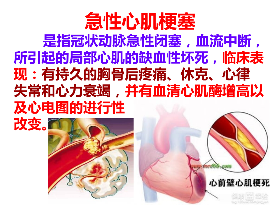 心肌梗塞.pptx_第2页