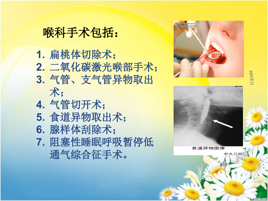 喉科手术的健康宣教幻灯片.pptx_第2页