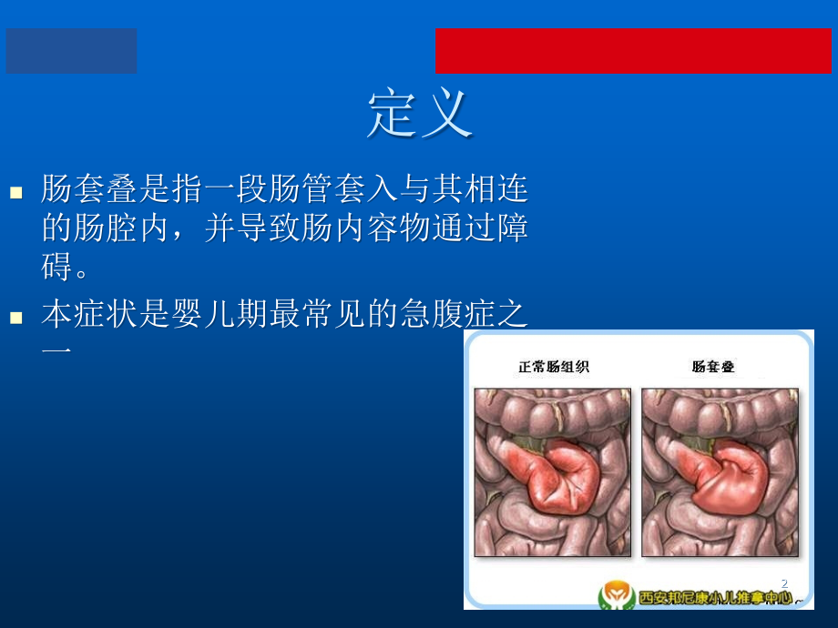 护理查房小儿肠套叠.ppt_第2页