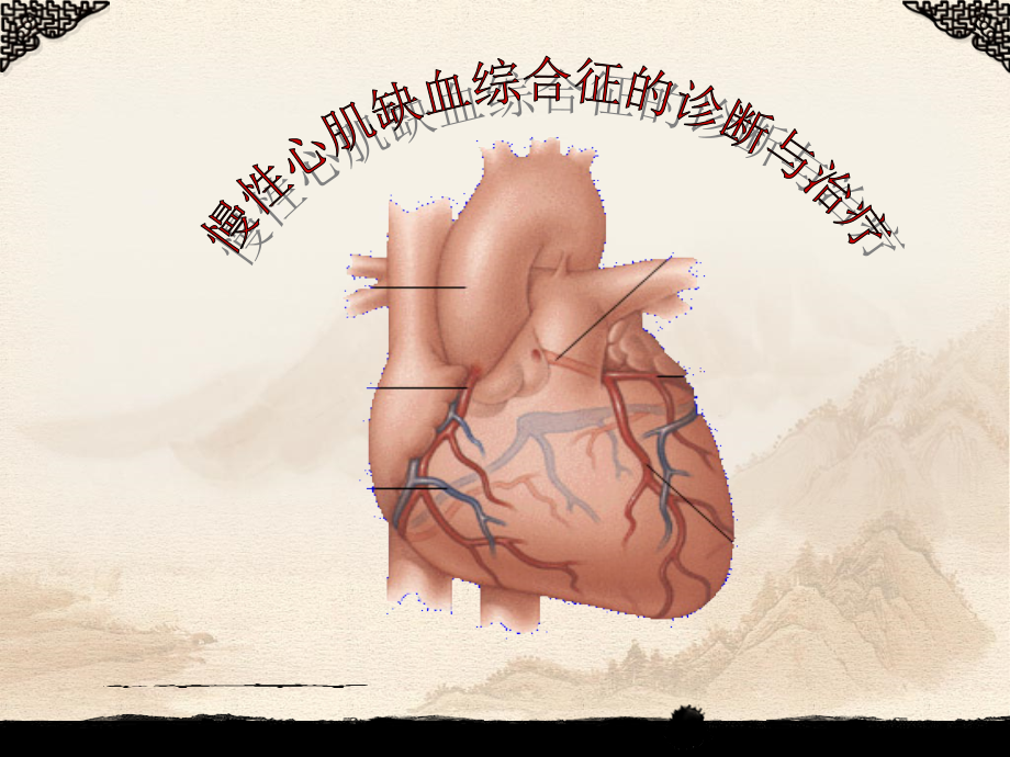 慢性心肌缺血综合症的诊断及治疗医学课件.ppt_第1页