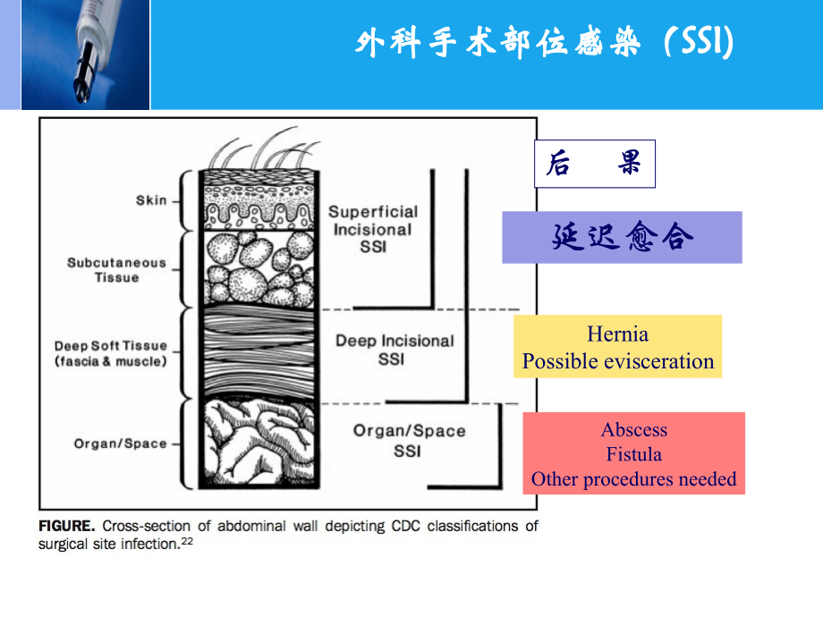 I类切口手术预防使用抗菌药物.ppt_第2页