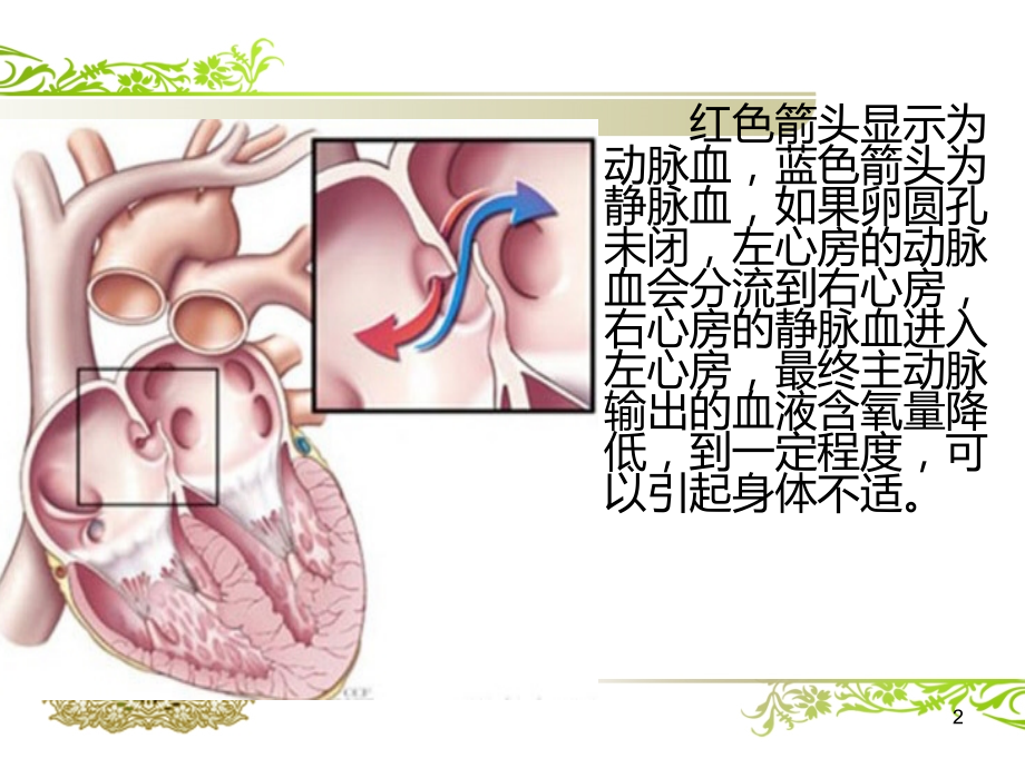 卵圆孔未闭的治疗及护理课件.ppt_第2页